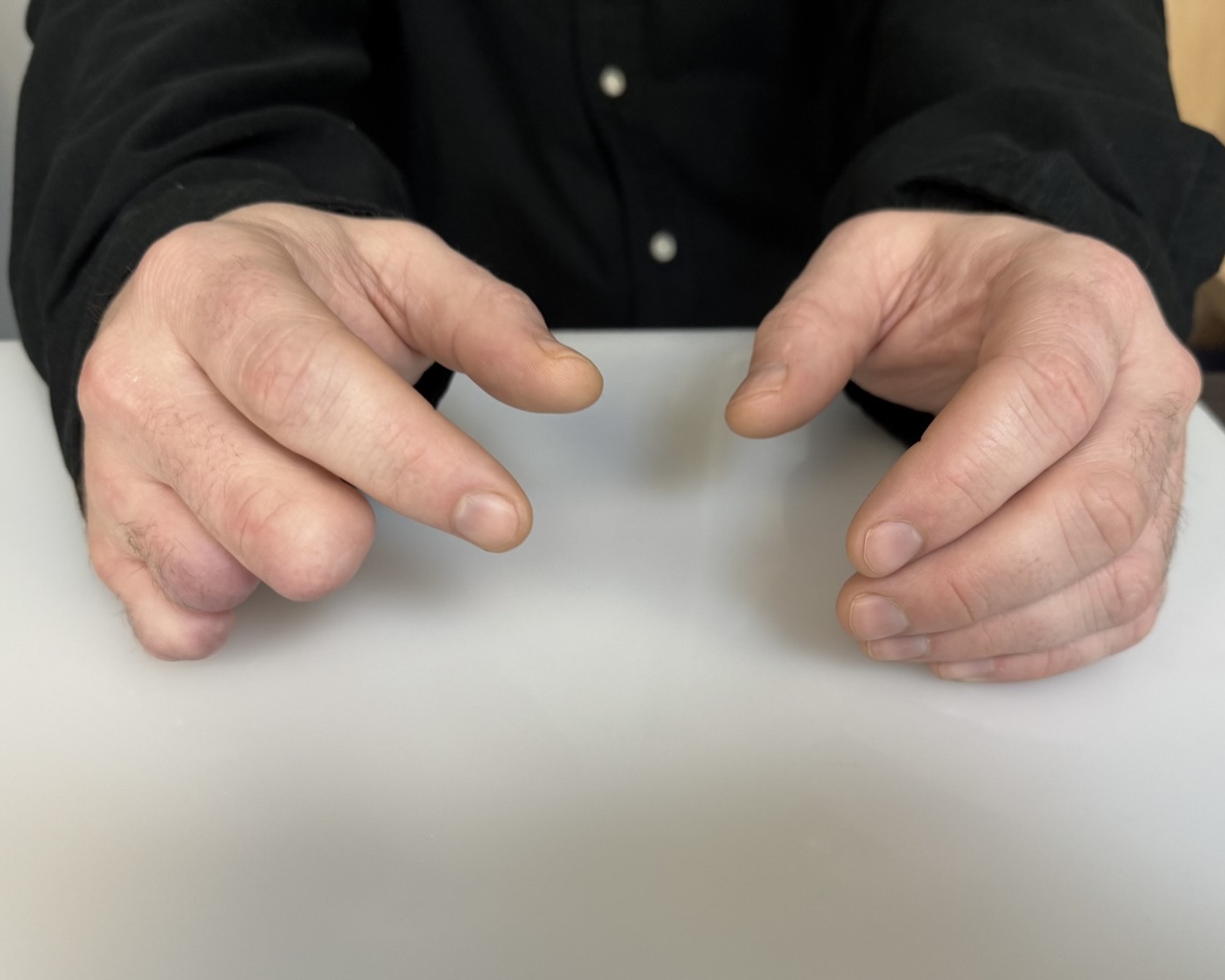 1 - Abbott silicone fingers 2026 before