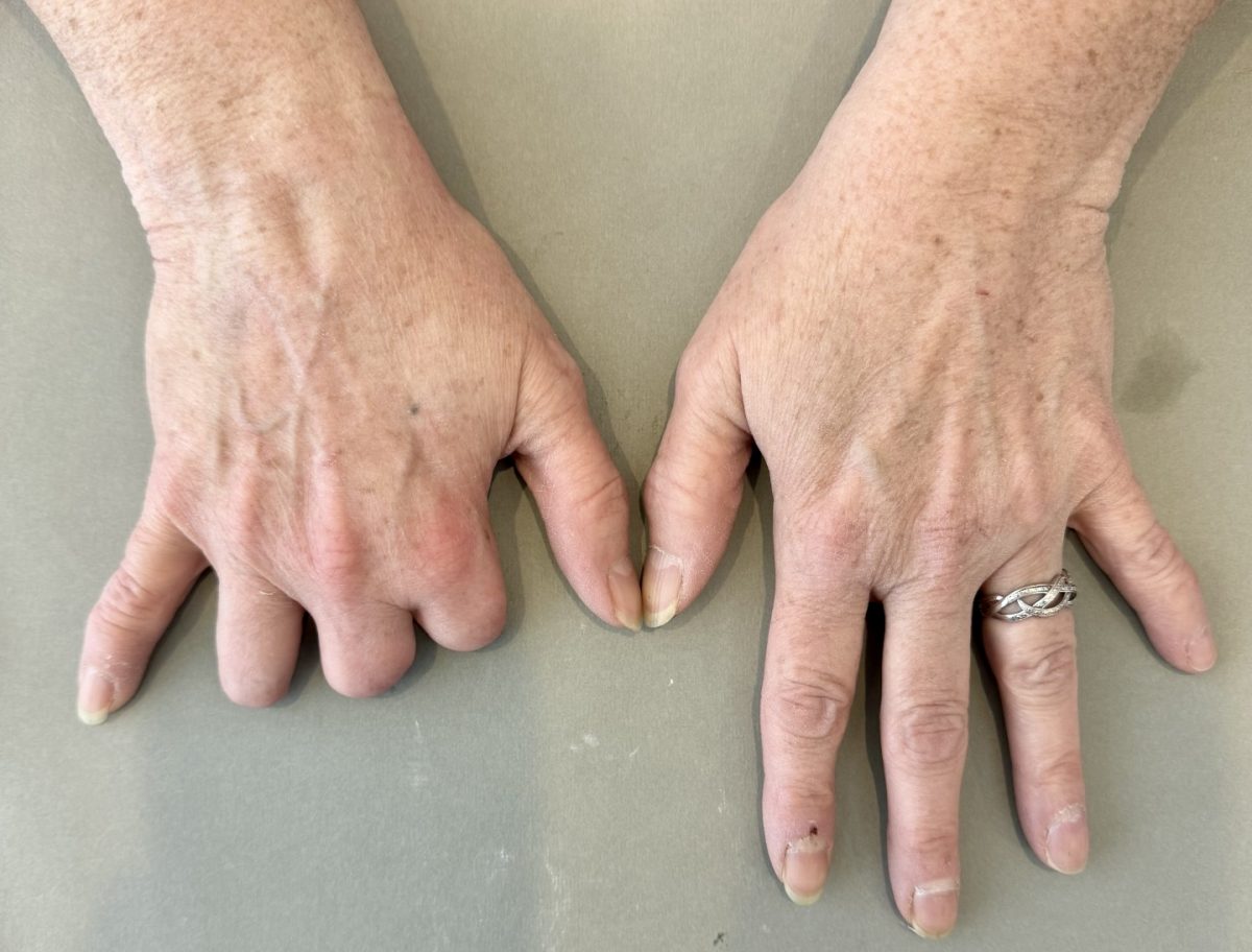 Christina silicone partial hand