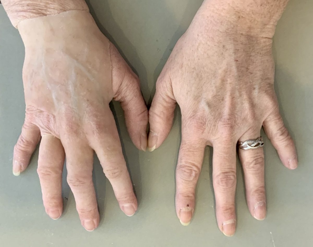 Christina silicone partial hand